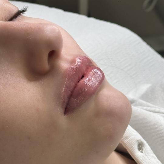 L’Avenue #beograd Mezoterapija lica Hydralips-mezoterapija usana hijaluronom