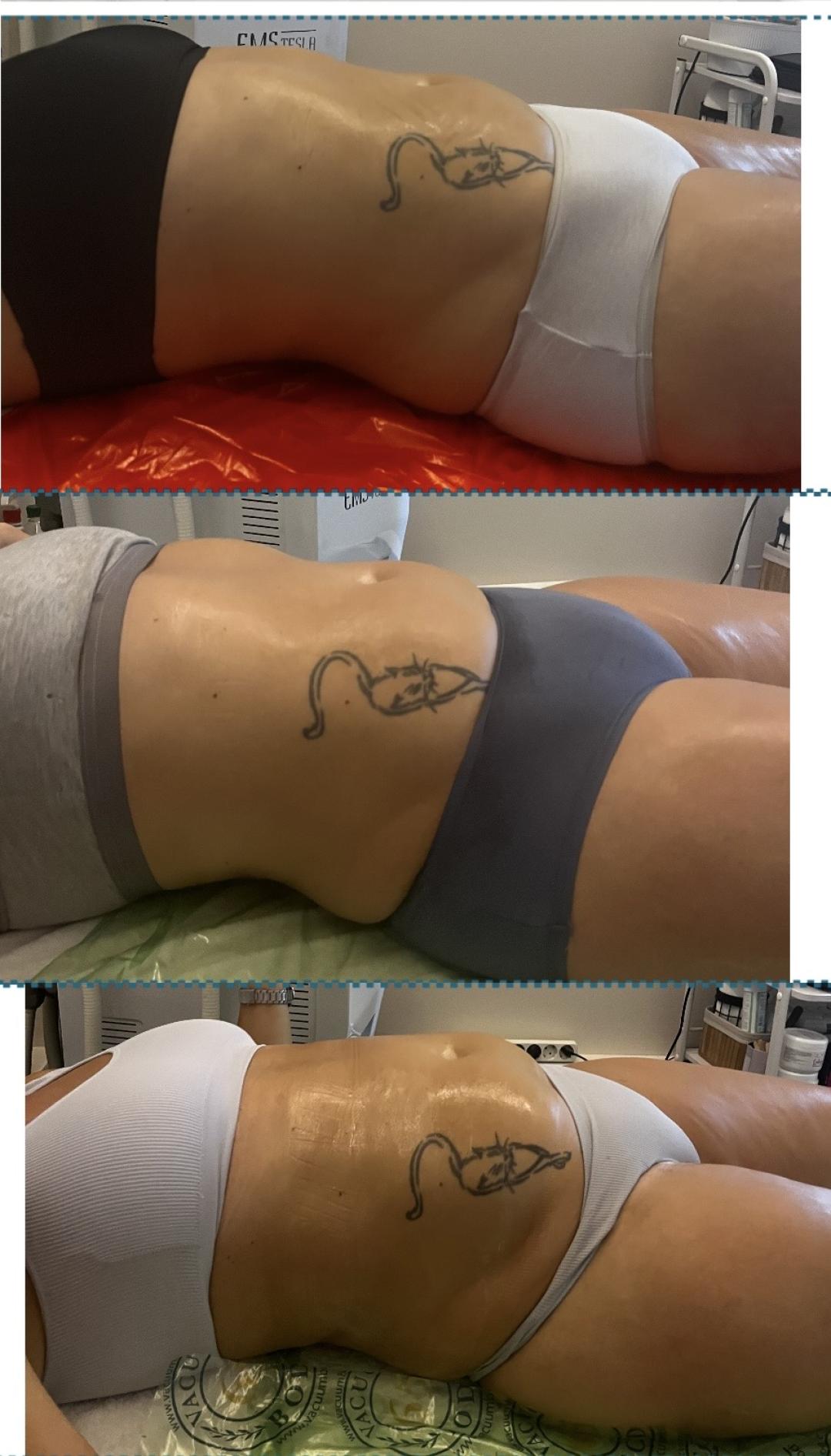 Diamond beauty M #beograd Anticelulit masaža Vacum 65 body + limfna drenaža