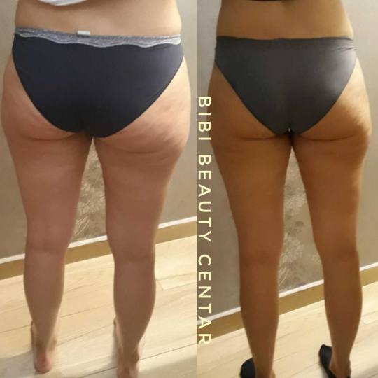 Bibi beauty centar #beograd Anticelulit masaža Maderoterapija  noge + stomak - paket od 10 masaža 