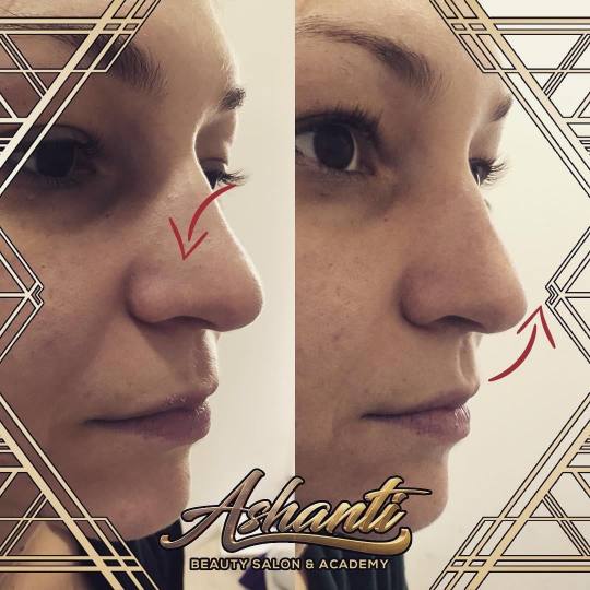 Ashanti Beauty Salon & Academy #beograd Tretman lica Plasma pen - podizanje nosa