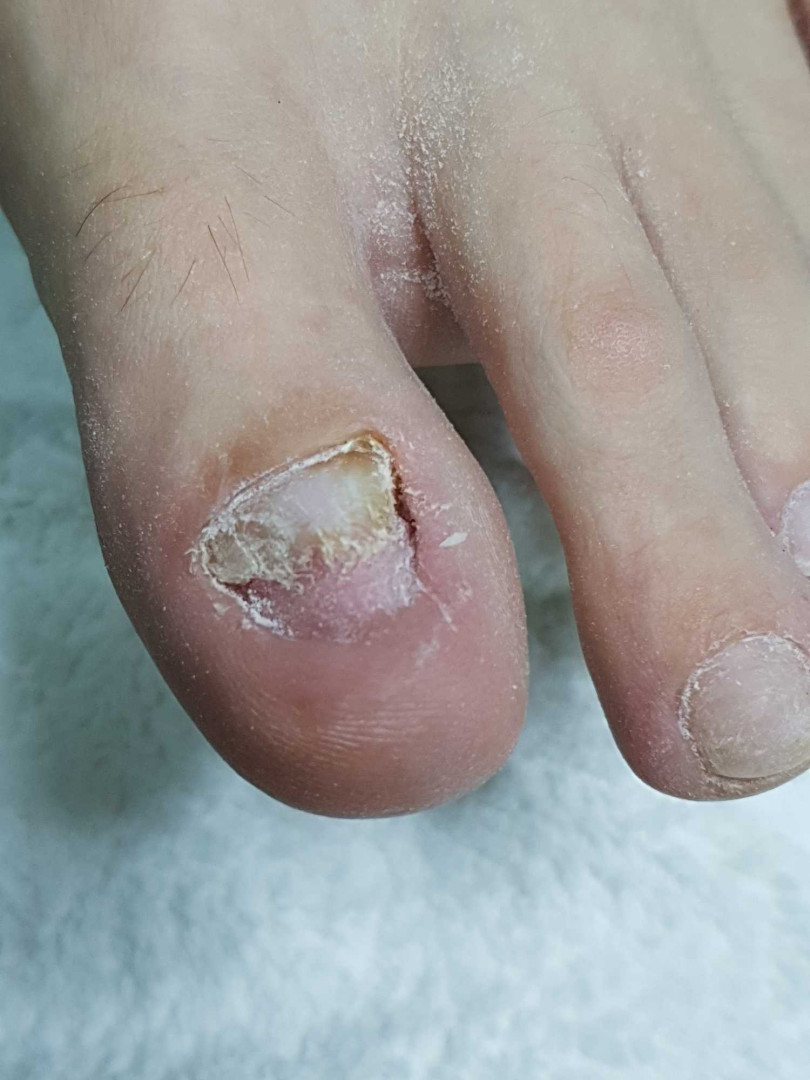 Tina B #beograd Medicinski pedikir Medicinski pedikir - gljivični / oboleli nokti
