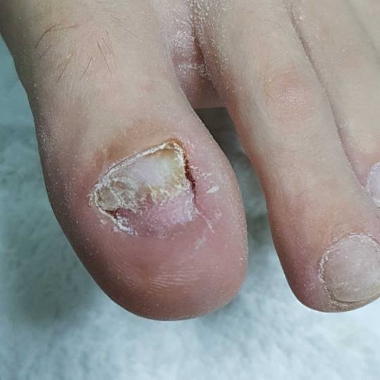 Tina B #beograd Medicinski pedikir Medicinski pedikir - gljivični / oboleli nokti