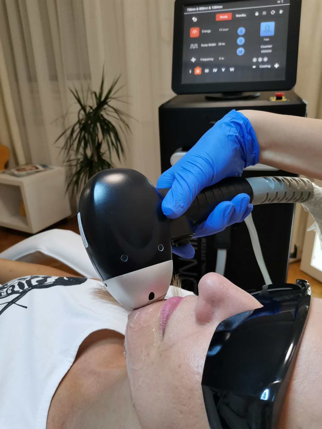 Glow beauty studio #beograd Laserska epilacija Laserska epilacija brade - za dame