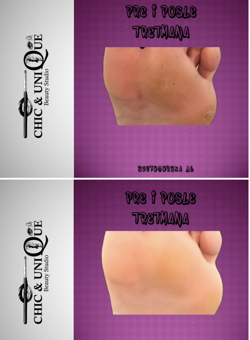 Chic & Unique Beauty Studio #beograd Medicinski pedikir