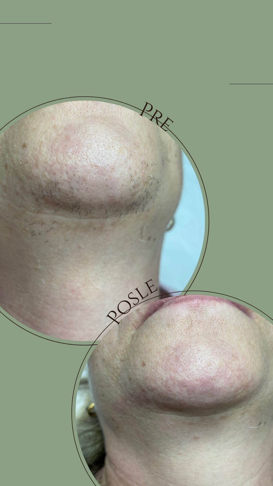 Beauty by Nevena Panić #beograd Laserska epilacija Laserska epilacija brade - za dame