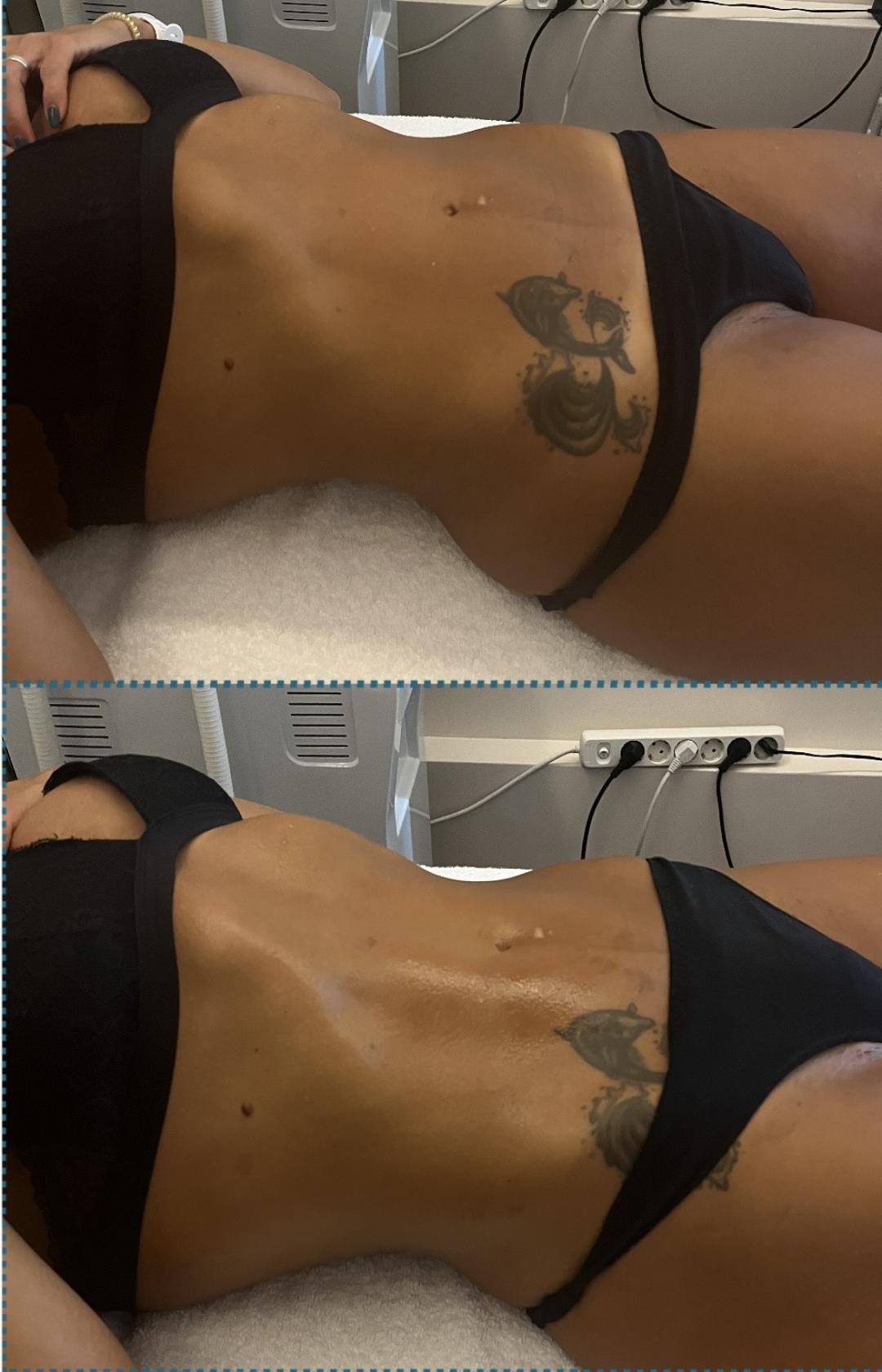Diamond beauty M #beograd Anticelulit masaža Vacum 65 body + limfna drenaža
