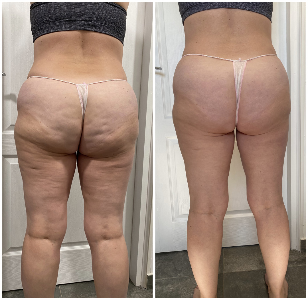 Tixy - Veternik #novisad Lifting / zatezanje kože Lipo ultrazvučna kavitacija + IR butine + gluteus + stomak + ruke