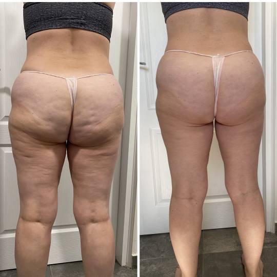 Tixy - Veternik #novisad Lifting / zatezanje kože Lipo ultrazvučna kavitacija + IR butine + gluteu