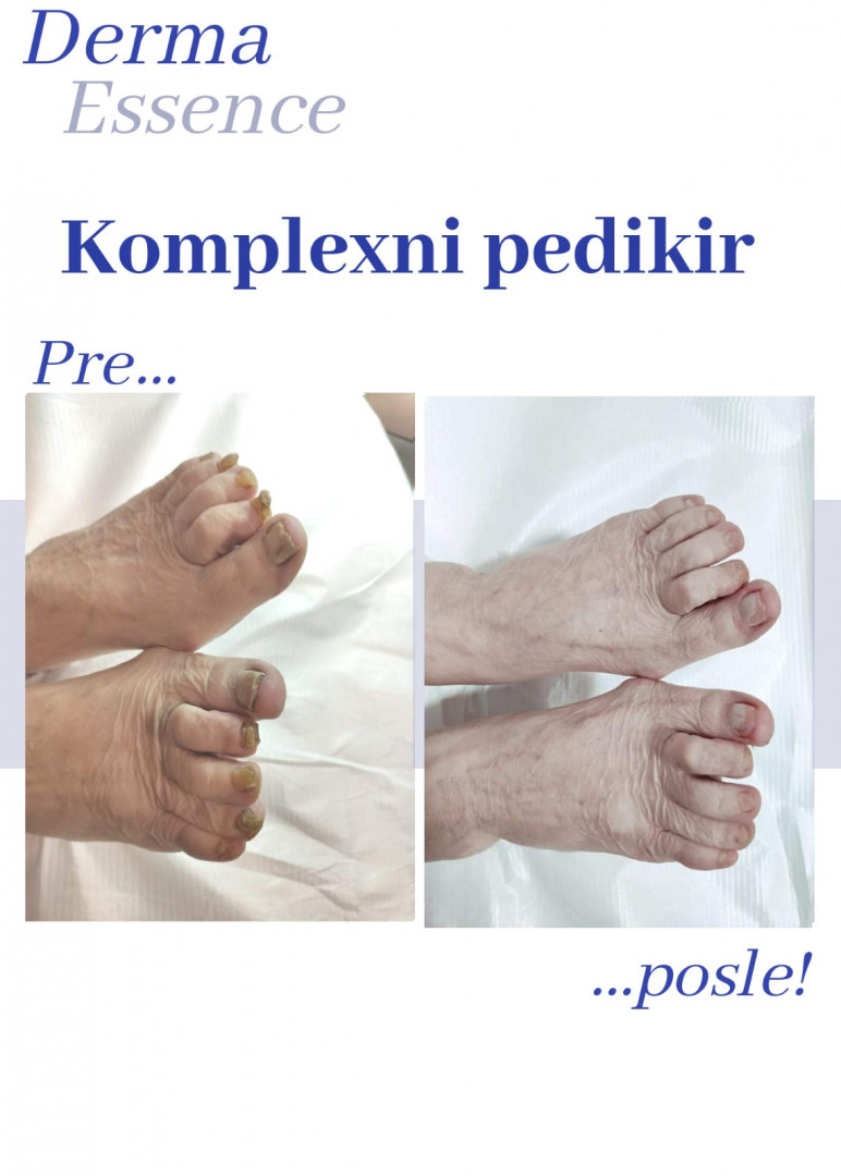 Derma Essence #nis Medicinski pedikir Kompleksni medicinski pedikir