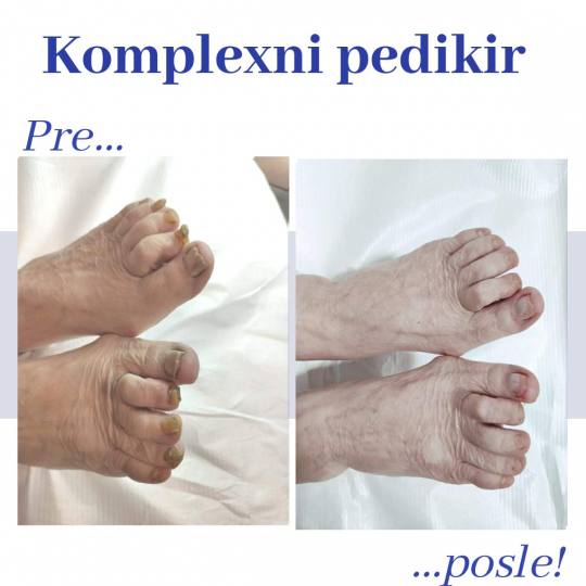 Derma Essence #nis Medicinski pedikir Kompleksni medicinski pedikir Zadebljali nokti