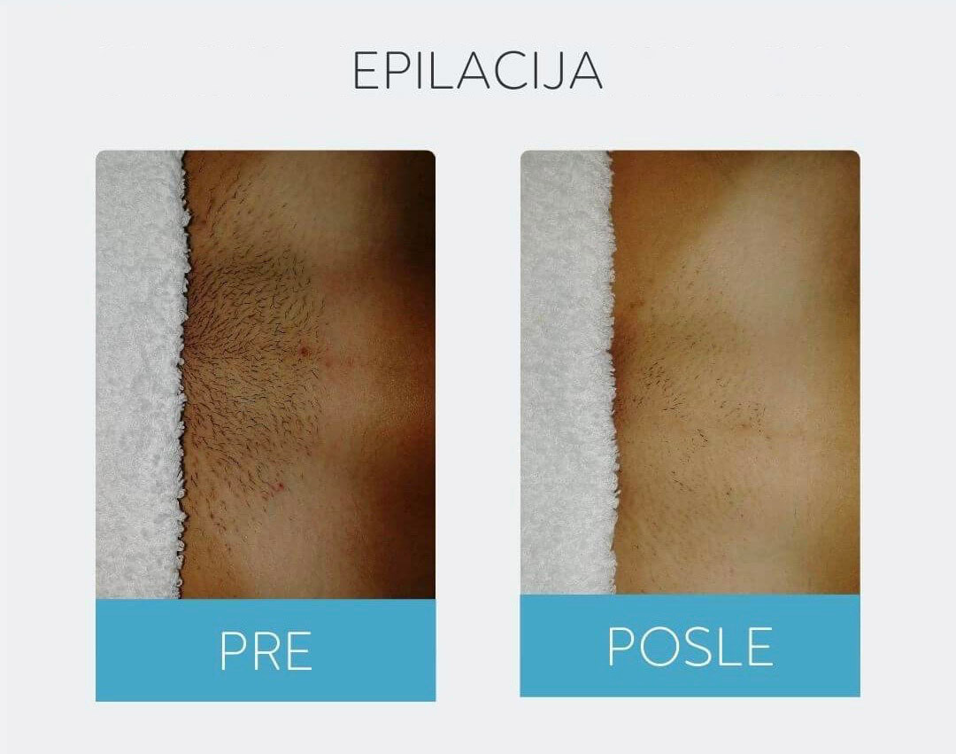 DepilConcept #beograd