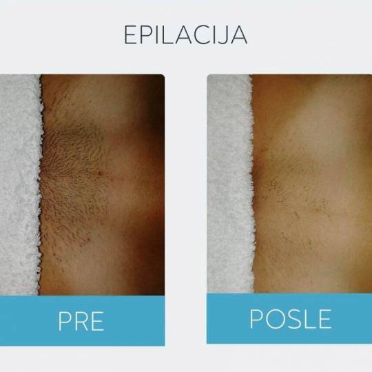 DepilConcept #beograd