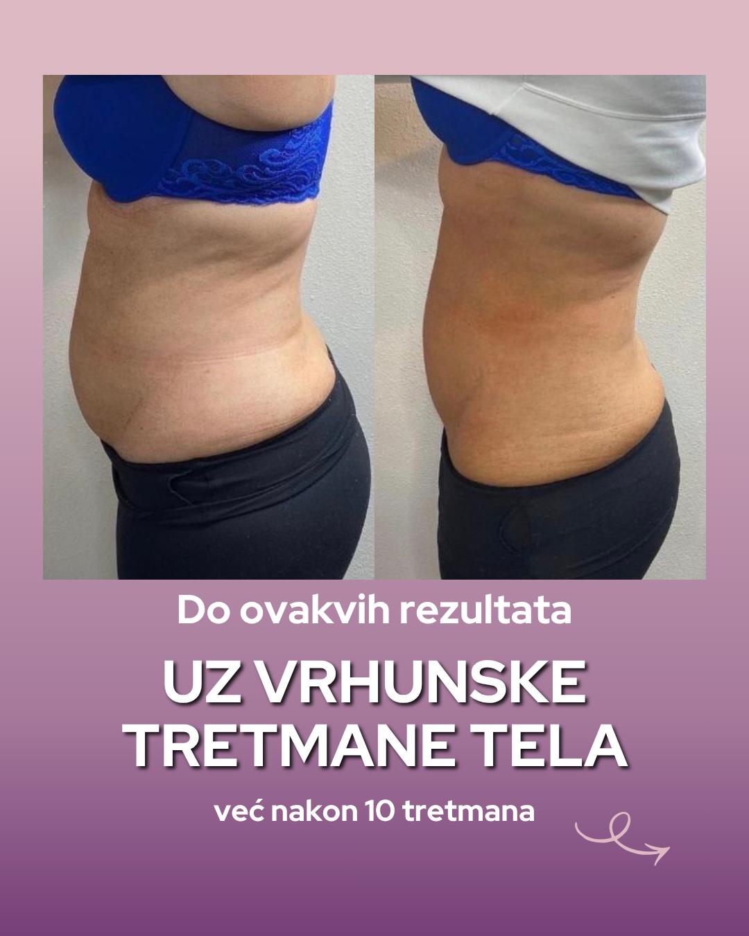 Kriolipoliza 1 regija + CelluShape 10 tretmana + 1 lipomodelovanje tela + 10 EMS / presoterapija - Natural Beauty Lux, Beograd Tretmani tela Telo Tretmani tela, Beograd, Bežanijska kosa, Bežanija, Ledine, Surčin