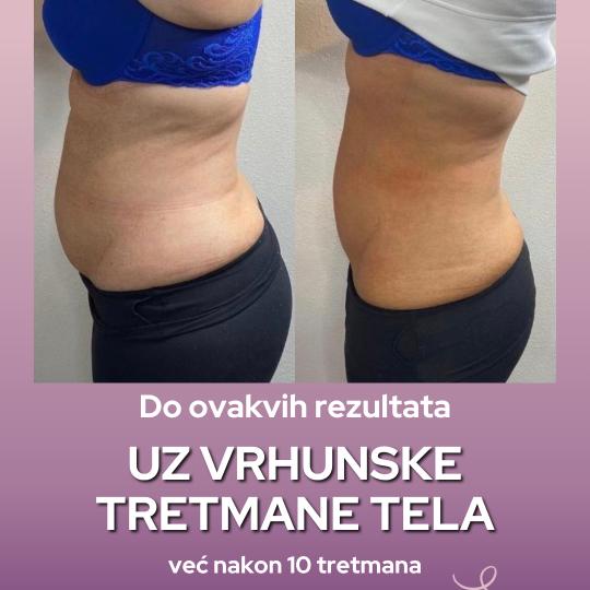 Natural Beauty Lux #beograd Tretmani tela Kriolipoliza 1 regija + CelluShape 10 tretmana + 1 lipomod