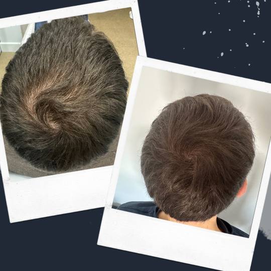 MediBella Aesthetic Dedinje #beograd Tretman rasta kose Hairecovery tretman - PRP kose + laserski tr
