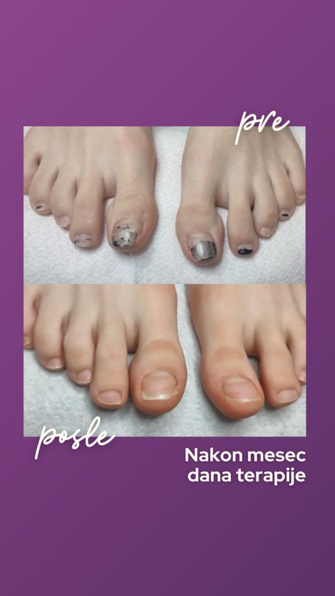 Biolaser za lečenje gljivičnih infekcija - jedno stopalo - Natural Beauty Lux, Beograd Estetski pedikir Nokti Estetski pedikir, Beograd, Bežanijska kosa, Bežanija, Ledine, Surčin