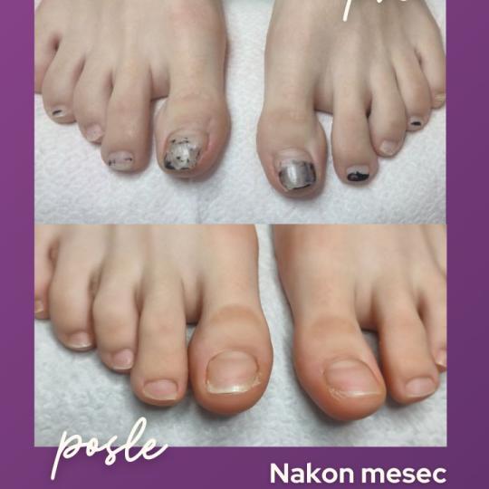 Natural Beauty Lux #beograd Estetski pedikir Biolaser za lečenje gljivičnih infekcija - jedno stop