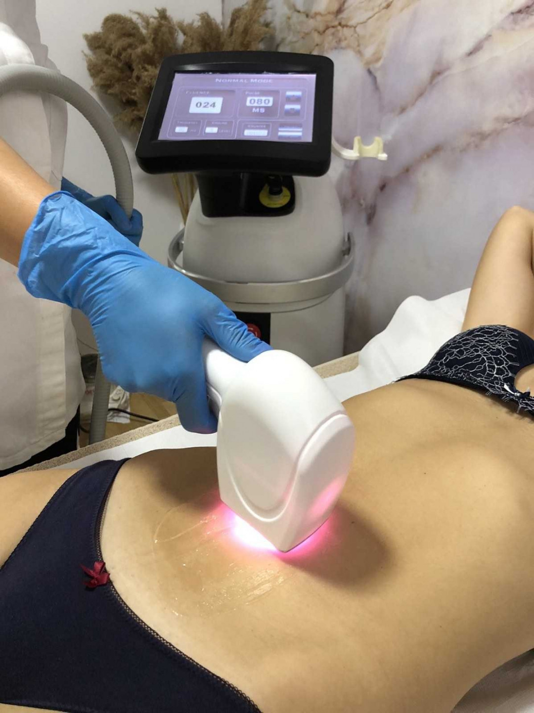 D&D Beauty Center #beograd Laserska epilacija Laserska epilacija linije stomaka - za dame