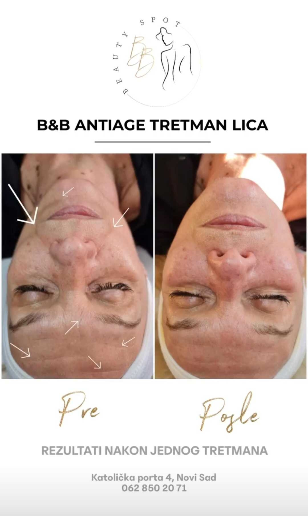 B&B Beauty Spot #novisad Tretman lica