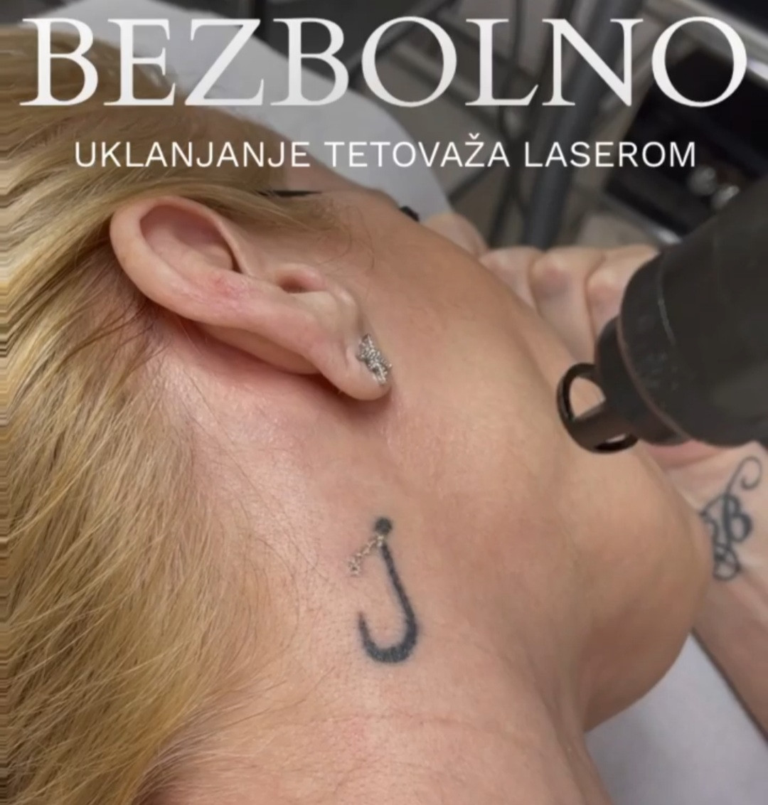 Laser centar Delight #beograd Uklanjanje tetovaža Uklanjanje tetovaže laserom - 1 boja 1cm2 - po tretmanu