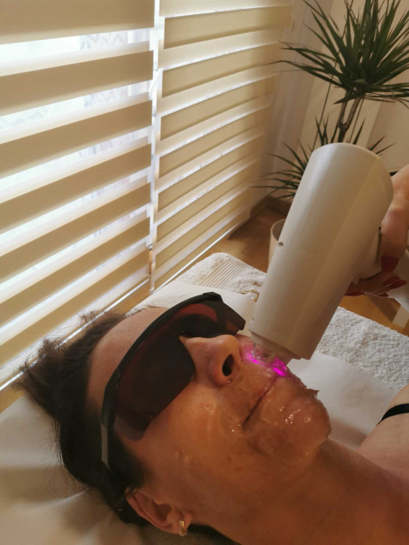 D&D Beauty Center #beograd Laserska epilacija Laserska epilacija celog lica - za dame