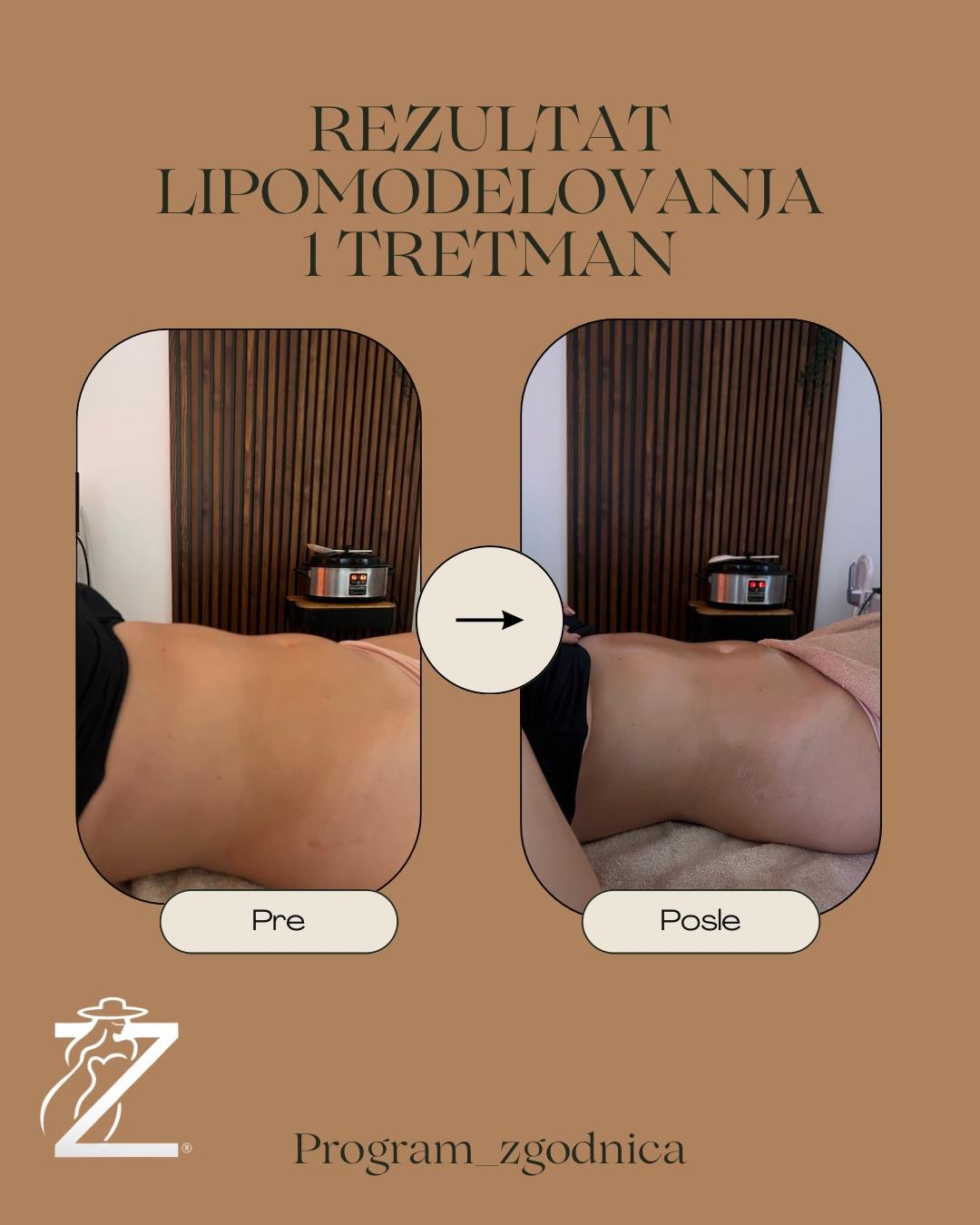 Brazilsko lipomodelovanje - stomak - Zgodnica, Beograd Anticelulit masaža Masaža Anticelulit masaža, Beograd, Jajinci