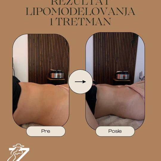 Zgodnica #beograd Anticelulit masaža Brazilsko lipomodelovanje - stomak Brazilsko lipomodelovanje j