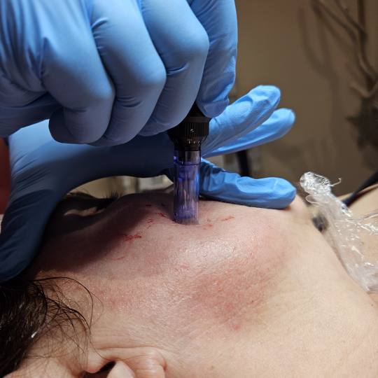 Starmedic #beograd Dermaroler i dermapen Dermapen tretman lica