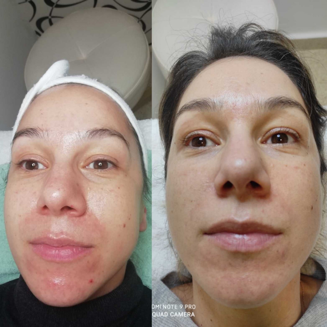 Olja Beauty #beograd Mezoterapija lica Mezoterapija