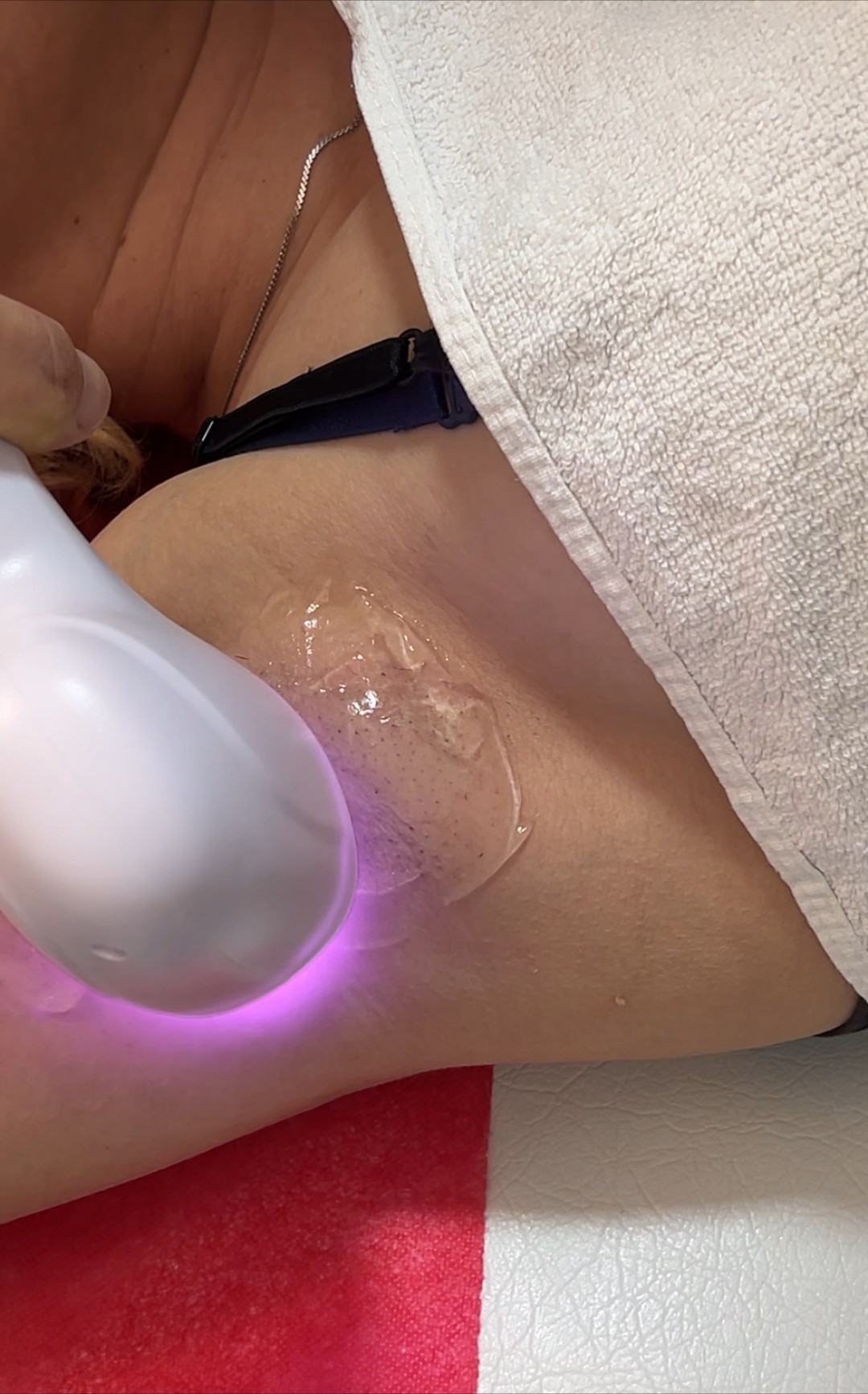 Odraz lepote #beograd Laserska epilacija Laserska epilacija pazuha - za dame