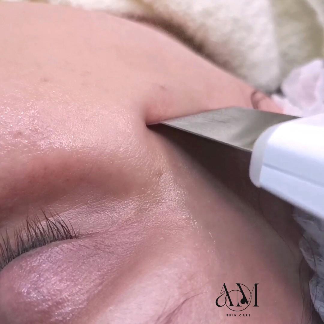 AM BEAUTY STUDIO #odzaci Radiotalasni i ultrazvučni tretmani Ultrazvučna špatula + dubinska hidratacija