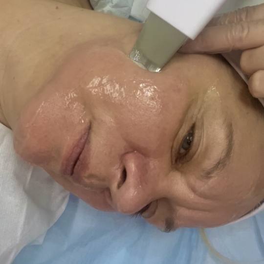 Estetski centar Vlahović #beograd Tretman lica Ultrazvučna špatula + ampula + maska + hladjenje