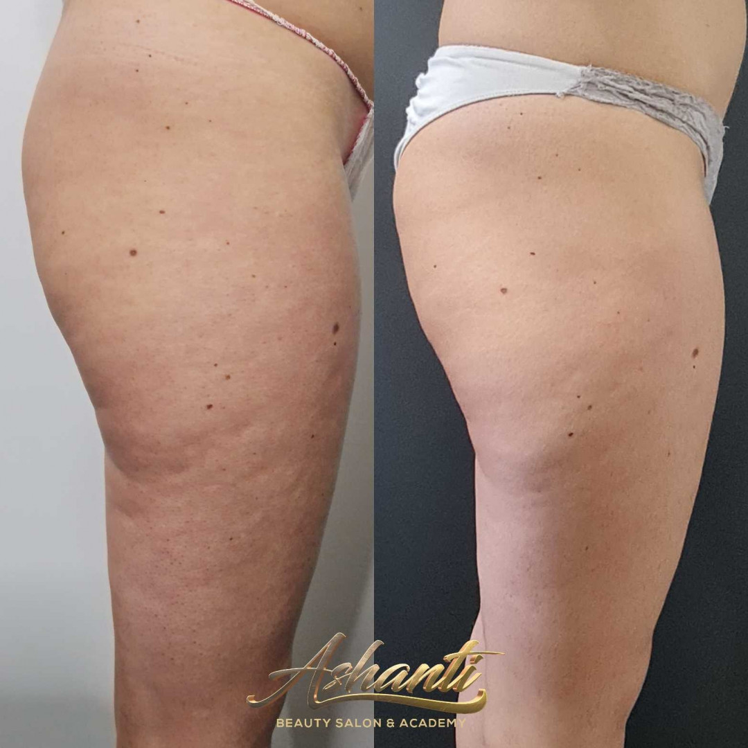Ashanti Beauty Salon & Academy #beograd Kavitacija Ultrazvučna kavitacija / radiotalasni lifting po regiji - paket od 10 tretmana