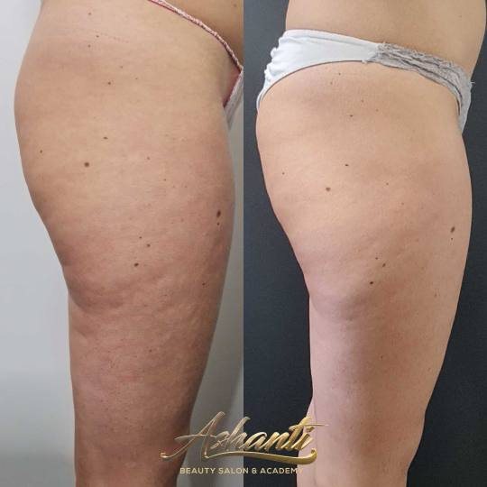 Ashanti Beauty Salon & Academy #beograd Kavitacija Ultrazvučna kavitacija / radiotalasni lifting po