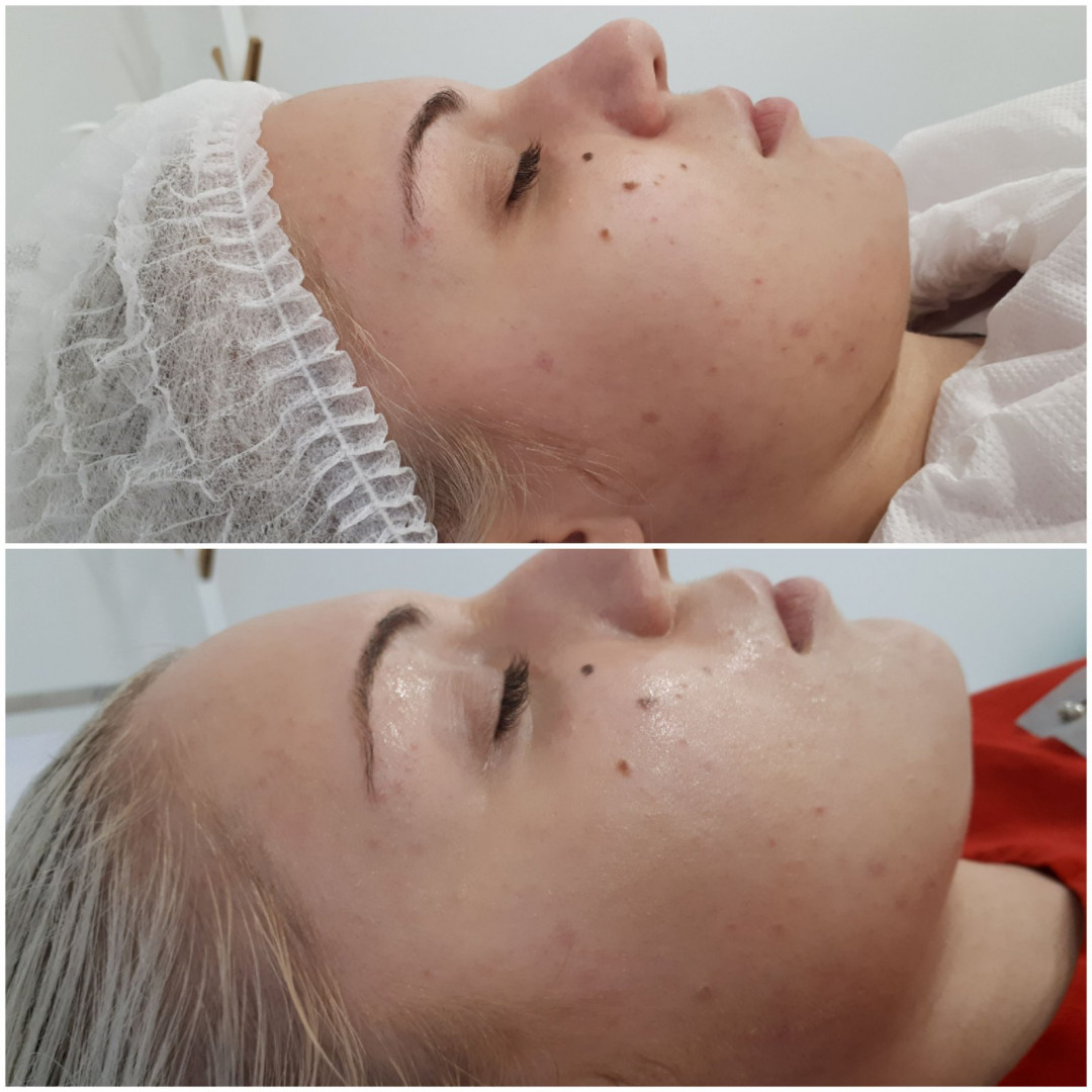 Essence of Beauty Academy #beograd Tretman lica Karbonski tretman lica