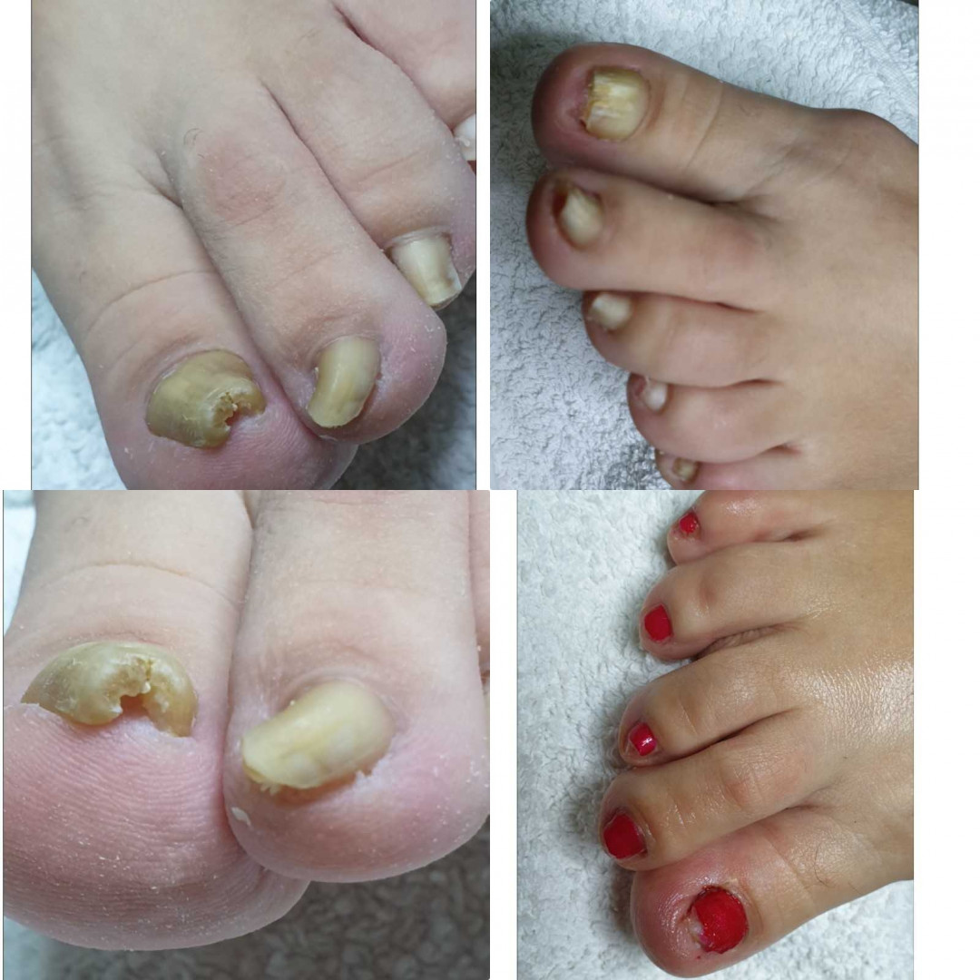 Tina B #beograd Medicinski pedikir Medicinski pedikir - gljivični / oboleli nokti