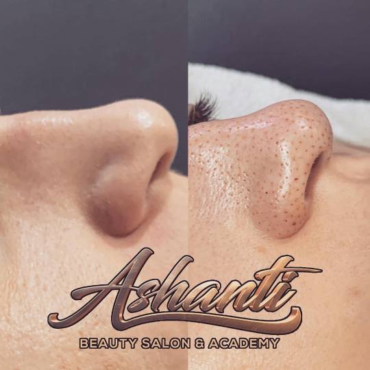 Ashanti Beauty Salon & Academy #beograd Tretman lica Plasma pen - podizanje nosa