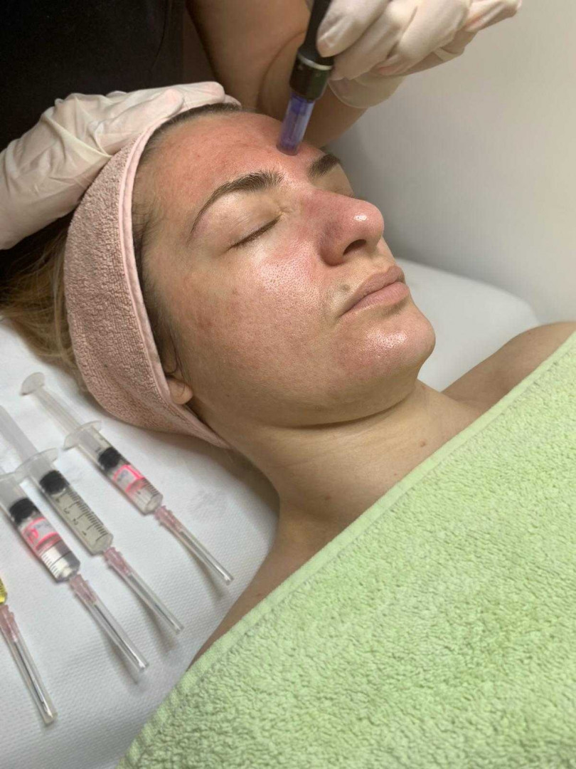 Sensus #beograd Dermaroler i dermapen Dermapen - za aknoznu kožu lica