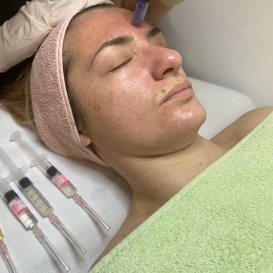 Sensus #beograd Dermaroler i dermapen Dermapen - za aknoznu kožu lica