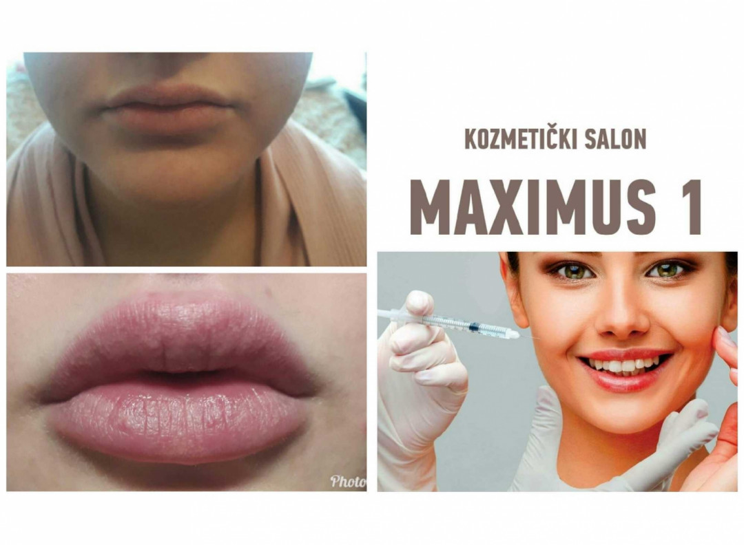 Maximus 1 #nis Hijaluronski tretmani lica