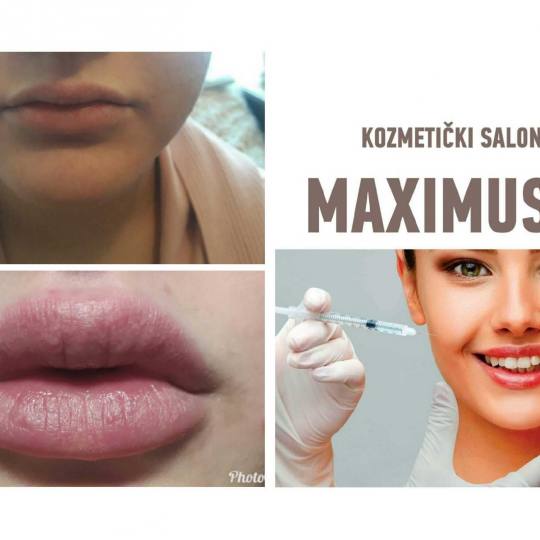 Maximus 1 #nis Hijaluronski tretmani lica Korekcija usana hijaluronskim filerima Hijaluronski fileri