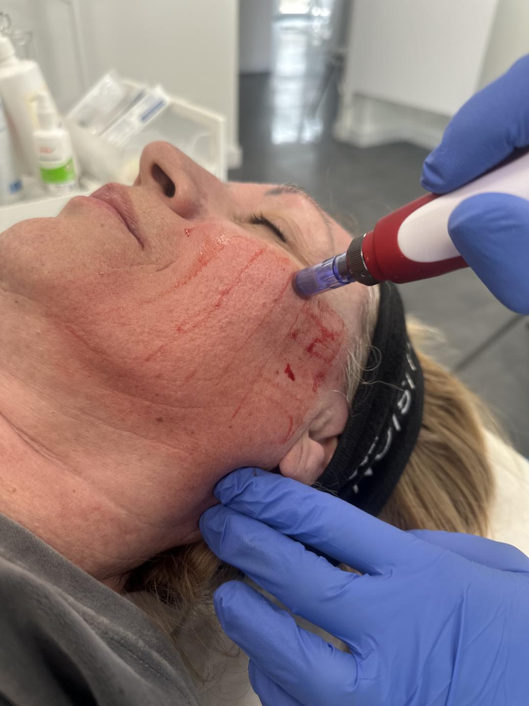 Egzozomi - lice - Beauty & Fashion, Beograd Tretman lica Lice Tretman lica, Beograd, Mirijevo