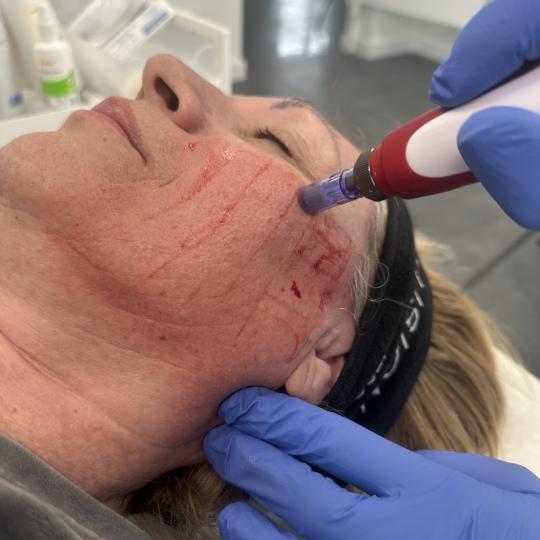 Beauty & Fashion #beograd Tretman lica Egzozomi - lice EGZOZOMI – nova era regeneracije kože ✨