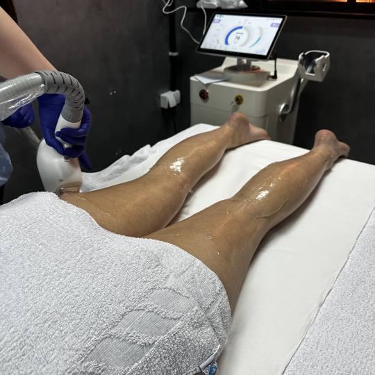 Laser centar Dodoš #beograd Laserska epilacija Laserska epilacija celih nogu - za dame Bezbolan tre