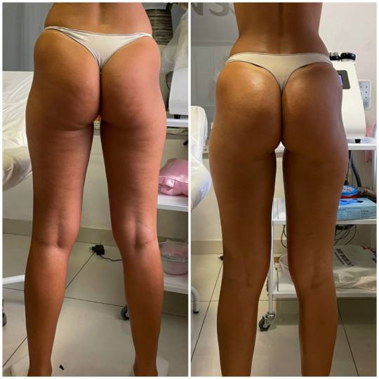 Lipolaser Centar - Matrix021 #novisad Tretmani tela Dubinski izvlačimo celulit, zatim ga razbijamo 