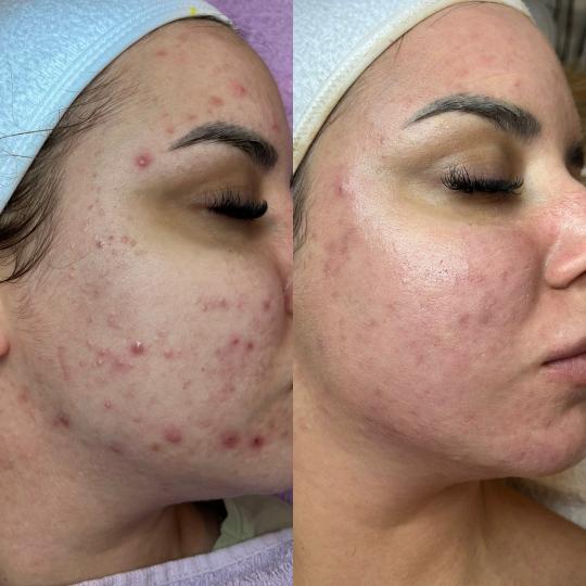 Bella Lunika Estetic studio #pancevo Tretman lica Tretman lica za problematičnu kožu - premium pak