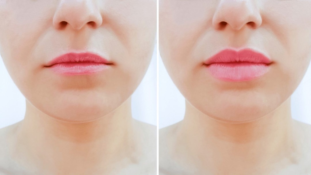 Dr Pantazis - Dental & Beauty Clinic #beograd Tretman lica Lip Flip