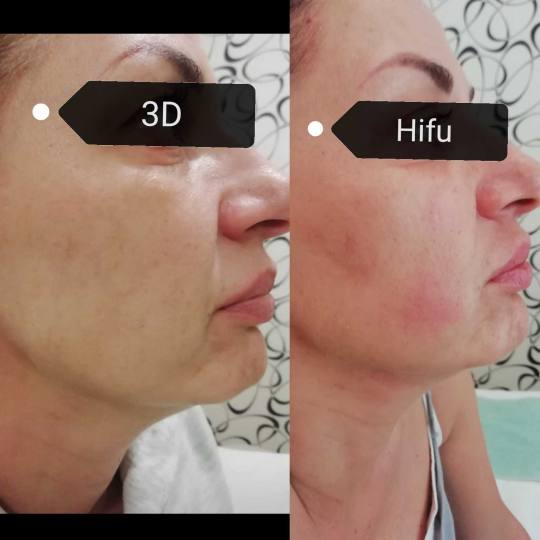 Olja Beauty #beograd Lifting / zatezanje kože HiFu tretman lica - po regiji 3D HIFU nehirusko zatez