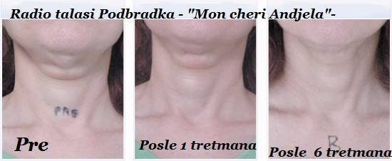 Mon cheri Anđela #beograd Tretmani protiv bora