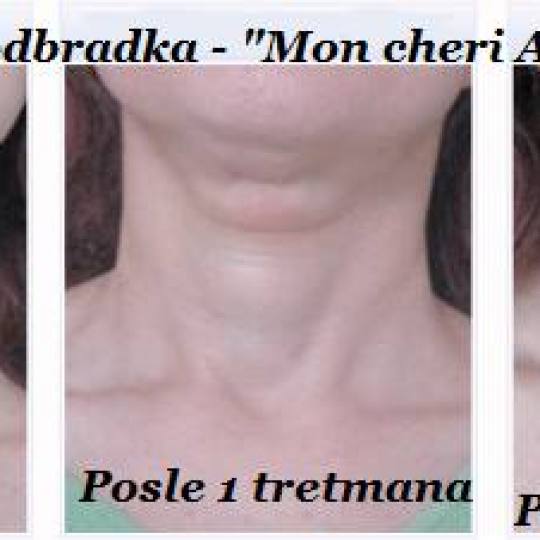 Mon cheri Anđela #beograd Tretmani protiv bora